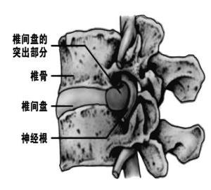 腰椎间盘突出症有哪些注意事项