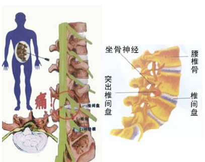 L4-L5/L5-S1椎间盘突出怎么治疗